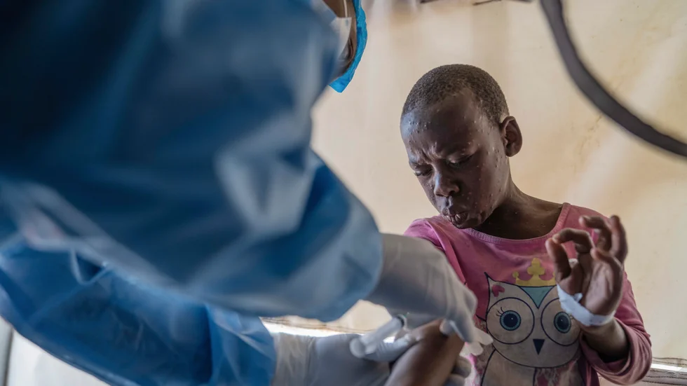 Ett barn med misstänkt mpox får behandling på en vårdinrättning i Munigi i östra Kongo-Kinshasa.
