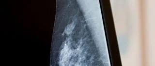 Tio frågor och svar om bröstcancer