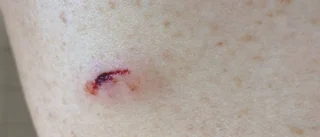 Attackerades av ilsken tjäder i skidspåret