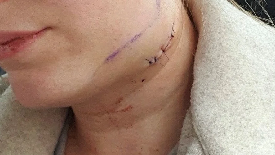 Joline har fått drygt 2 000 kronor av tandvårdskedjan My Dentist för sveda och värk. "Det är alldeles för dåligt med tanke vad jag har utsatts för". Från Patientförsäkringsföreningen kom 3 000 kronor.
