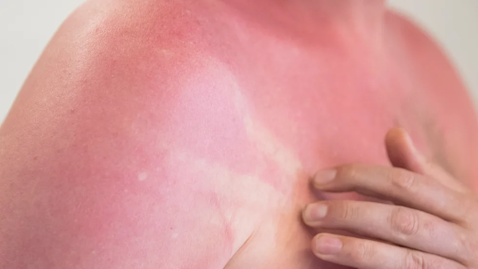 Du behöver inte ens bli bränd för att solen ska vara skadlig och kunna ge upphov till hudcancer. Arkivbild.