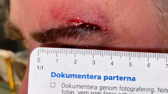 En sårskada över ögonbrynet uppstod på en av männen under tumultet på O'learys i Piteå. Nu åtalas den yngre mannen för misshandel och för våldsamt motstånd.