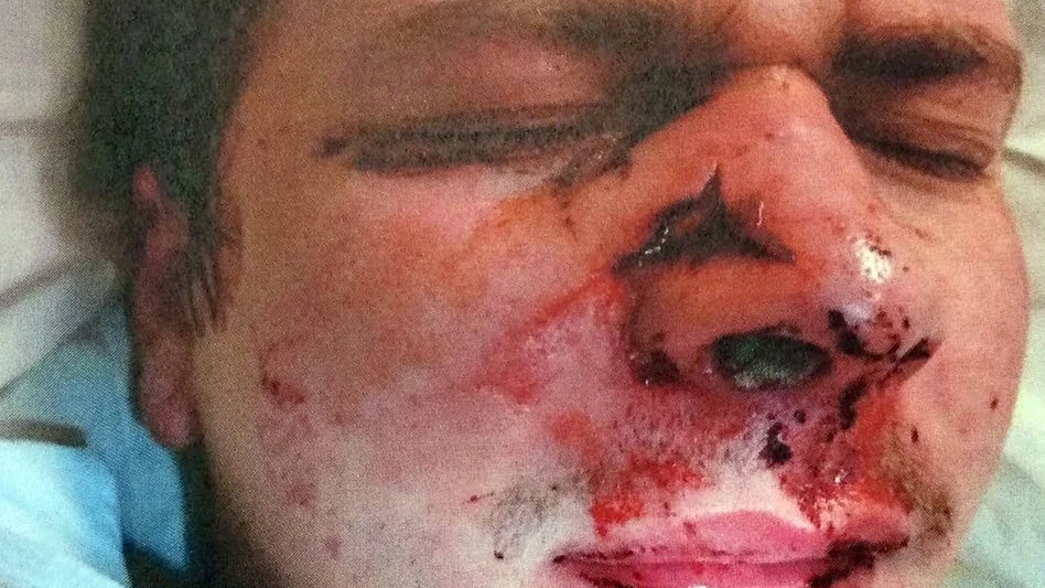 Skador. Philip Ödalen-Kronvald fick flera bestående skador. Han brottas fortfarande med huudvärk och har månfa vankrydande ärr i ansiktet. Han syddes med över 20 stygn. BIiden är tagen timmarna efter misshandeln.
