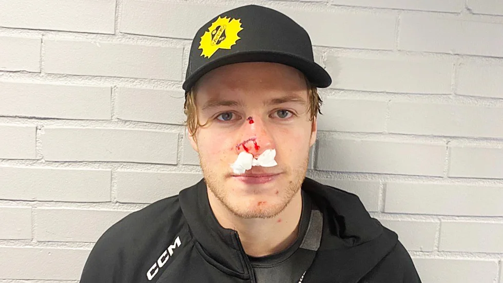 Rickard Hugg med ett riktigt fighting face efter matchen. Det blev några stygn rakt över näsan.