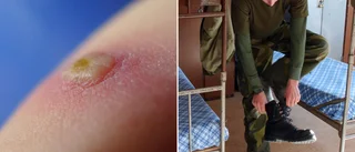 Kille gjorde militärtjänst – fick stora bölder på kroppen