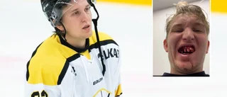 Brutala skräckskadan – fyra tänder borta och spricka i käken: "Jävligt segt att äta soppa ett bra tag framöver"