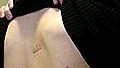 Rikard Gustafsson är märkt för livet efter knivdådet utanför Eriksbergsskolan den 30 november förra året. De två mindre ärren visar var gärningmannen högg honom. Det långa ärret, som fortsätter en bra bit fram på bröstet, är efter operationen.
