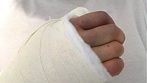 Nygipsad. Ylva Stålnacke har brutit sin högerhand för fjärde gången i sin karriär.