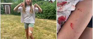 Mathilda, 7 år, blev biten av gädda – fick sy fem stygn: "Sjukt"
