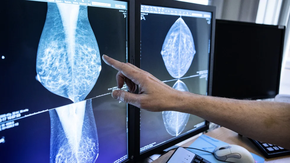 "AI ger lika träffsäkra bröstcancerdiagnoser som en röntgenläkare, den bästa algoritmen var till och med något bättre än radiologerna på att hitta cancerfallen", skriver debattörerna.
