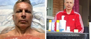 Skulle ta bort hår - fick andra gradens brännskador
