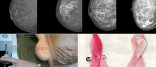 ”Täta bröst” • Så många kvinnor har det på Gotland • Därför ökar det risken för cancer