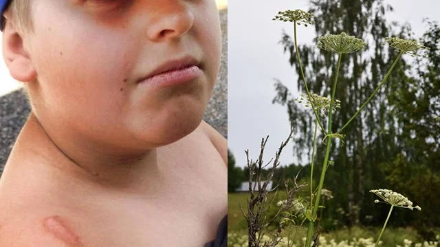 Bränd. Max Lång, 11år, fick för tre veckor sedan en brännande märke från en jätteloka. "Han har haft jätteont" säger mamma Linda Lindgren.