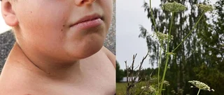 Brännmärke och svullen läpp efter mötet med jätteloka