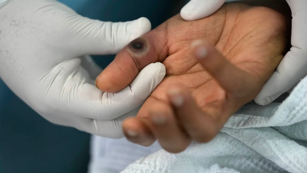 En patient med apkoppor på ett sjukhus i Perus huvudstad Lima.