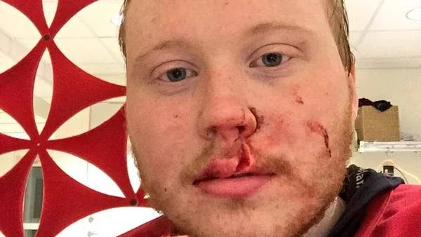 Aj aj. Hertsörinkens sforward Tom Niemi fick sy 19 stygn efter kvalmatchen till division 2.