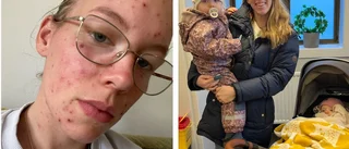 Vattkopporna blev en mardröm för tvåbarnsmamman Josefin, 27