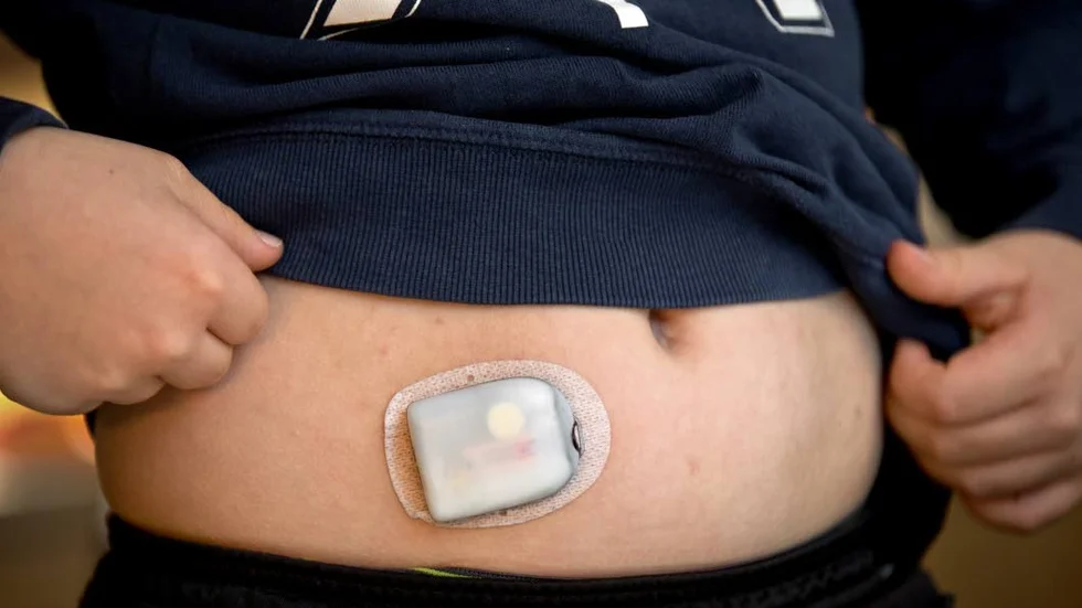 Insulinpump. Underlättar för diabetespatienter att styra insulinet.