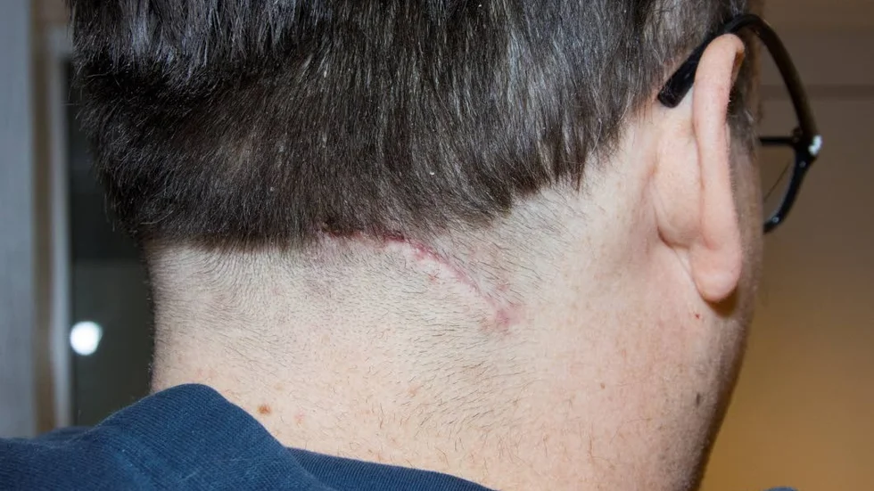 Såret. Offret genomgick två operationer och hade inte vittnet samt läkarna lyckats stoppa blodflödet hade mannen kunnat avlida. En ven i halsen brast pch han fick sys med sex stygn.
