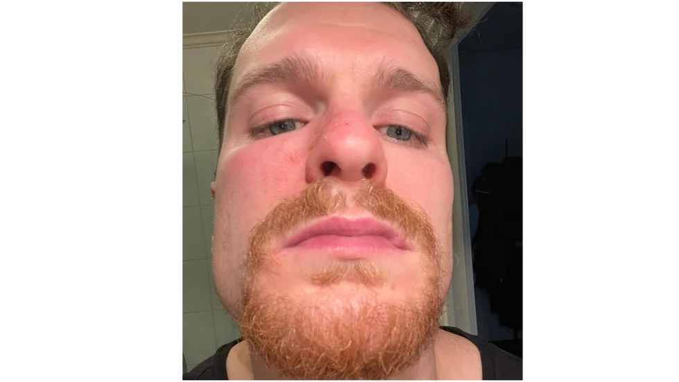 Brendan Shinnimin tog bild för att visa upp svullnaden under ögat.