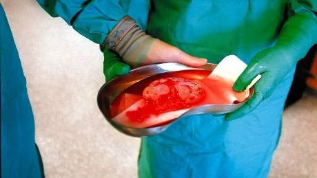 NY NJURE. En donerad njure kan vara skillnaden mellan liv och död för den som är uppsatt                      på väntelista för en transplantation. Foto: Håkan Gidlöw