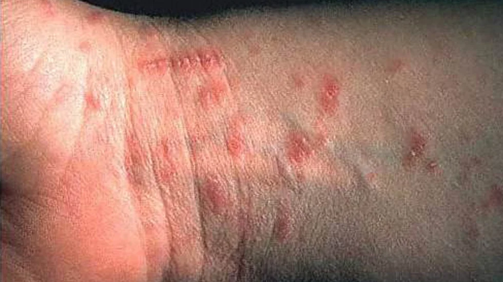 Det mikroskopiska skabbkvalstret gör små gångar i hudens yttre lager där de lägger sina ägg. Ett vanligt symptom är nattklåda.