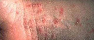 Flera fall av skabb – men troligtvis ingen våg