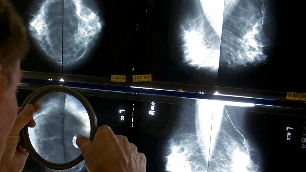 Mammogram.