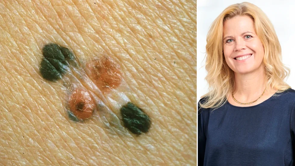 Malignt melanom är den tredje vanligaste cancertypen i Sverige. "Regelbunden självundersökning av kroppen är en livsviktig rutin för att upptäcka cancer i ett tidigt skede", säger Annika Svedberg, chefsapotekare på Apotek Hjärtat.