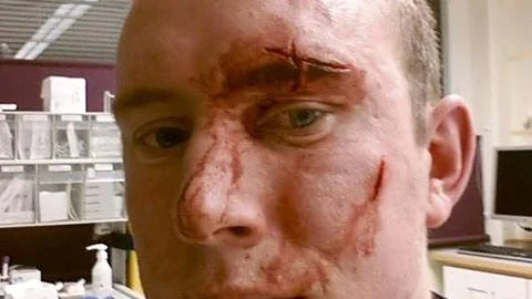 Så här kan en bandyspelare se ut efter att ha krockat med ett galler. Men August Kindvall repade sig snabbt.
