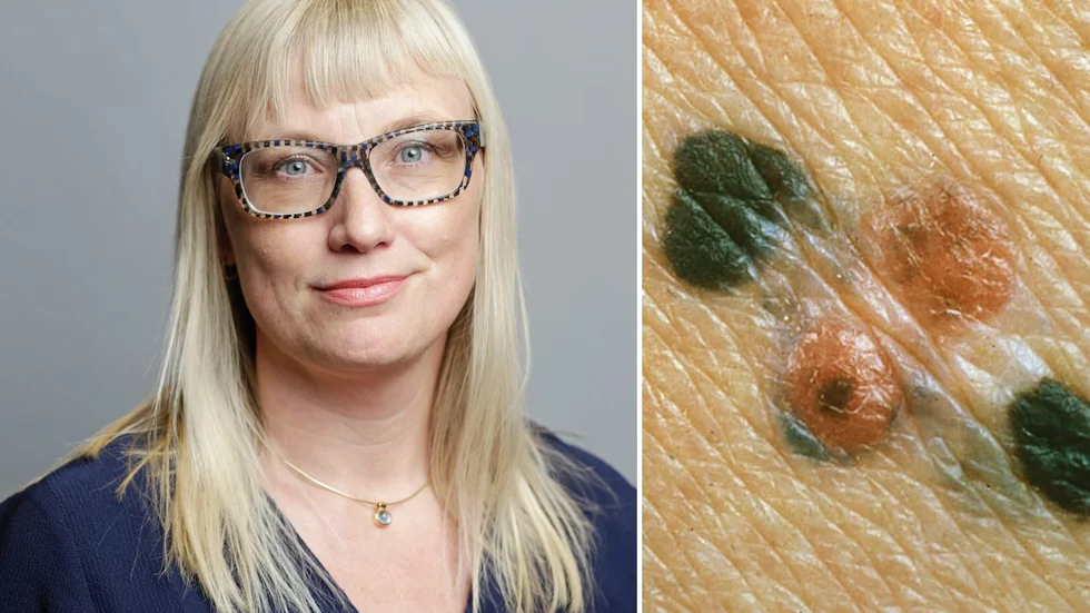 Malin Sjöberg-Högrell (L), ordförande sjukhusstyrelsen, glädjs åt att metoden teledermatoskopi införs i Region Uppsala. Med metoden kan hudförändringar (till höger exempel på malignt melanom) undersökas på distans.