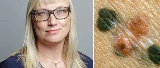 Så kan hudcancer upptäckas - på distans