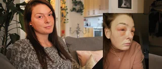 Allergichock av kräm: "Det brann runt ögonen"
