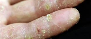 Ökad livskvalitet för psoriasissjuka