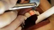 När man borrar i tanden med laserteknik används vatten i kombination med laser för att ta bort tandytan.