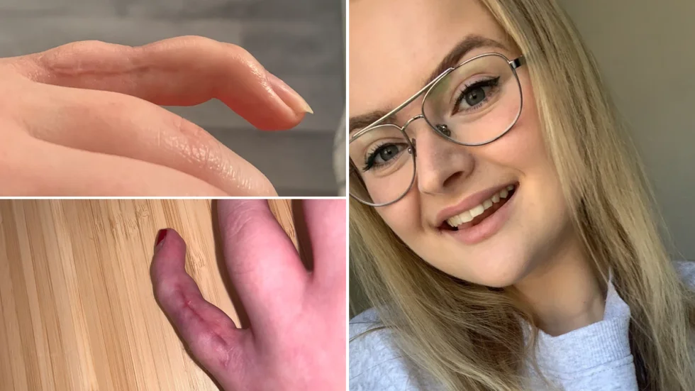 25-åriga Linnéa Josefsson, från Vingåker skadade fingret och tvingades förra året till en akutoperation på Mälarsjukhuset. Den resulterade i stor smärta och oförmåga att böja fingret under nästan ett års tid. Efter en ny operation på Sös, Södersjukhuset i Stockholm, där de bland annat tog bort en mycket stor skruv som stack ut, har hon återfått delar av rörligheten.