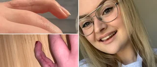 Operationsmissen kunde ha förstört Linnéas finger: "Jag litade ju på att de visste vad de gjorde"