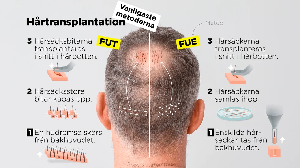 De vanligaste metoderna för hårtransplantation, FUT och FUE.