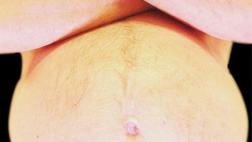 Män med övervikt kan lida av för låg testosteronnivå.
