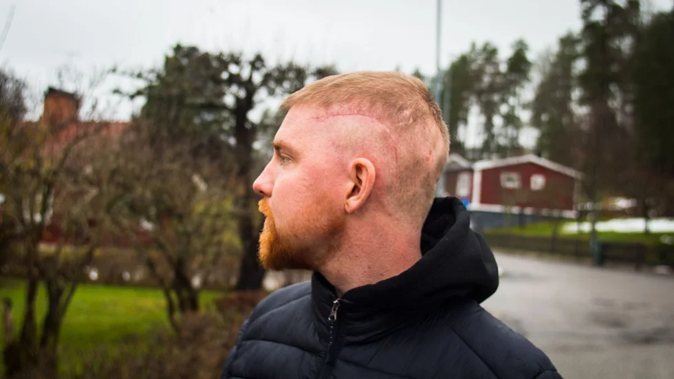Philip Tordsson visar upp ärret efter de 24 stygnen efter operationen. "De kunde inte ta bort allt, men de kunde ta bort det mesta. Sedan dess är jag en gladare och positivare person", säger han.