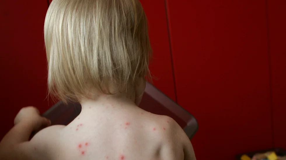 Folkhälsomyndigheten ser över om vaccination mot vattkoppor ska ingå i det nationella vaccinationsprogrammet.