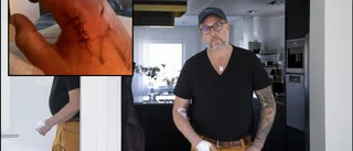 Jocke fick svår infektion efter grannkattens bett