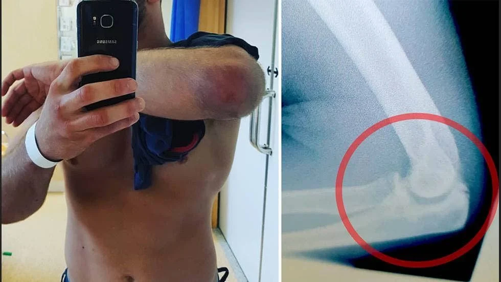 Johannes Lundströms arm bröts efter tumult med väktare. Händelsen polisanmäldes som misshandel men polisen har lagt ner förundersökningen med motiveringen attt gärningen förefaller rymmas inom laga befogenhet.