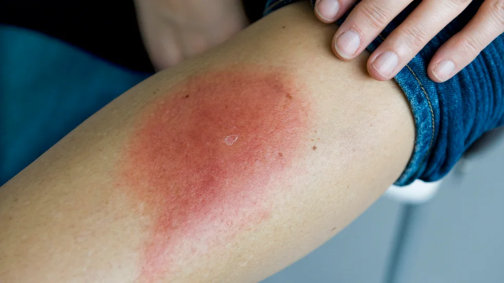 Hudrodnad är ett vanligt symtom på borrelia men vissa får inga symtom alls. Arkivbild.