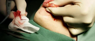 Kvinna tvingades till akut operation efter rumpimplantat