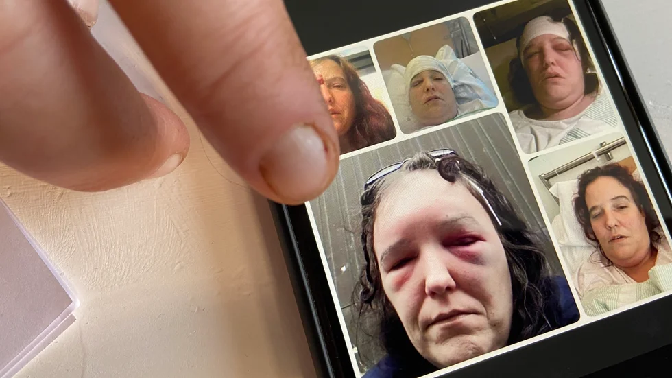 Ibland har läkarna gått in genom huvudet, ibland genom näsan. De senaste tio åren har Lena Sjögren genomgått mellan 25 och 30 operationer." Jag har tappat räkningen", säger hon. 