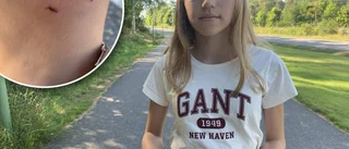 Råtta attackerade Jennifer, 14: "Den bet sig fast"