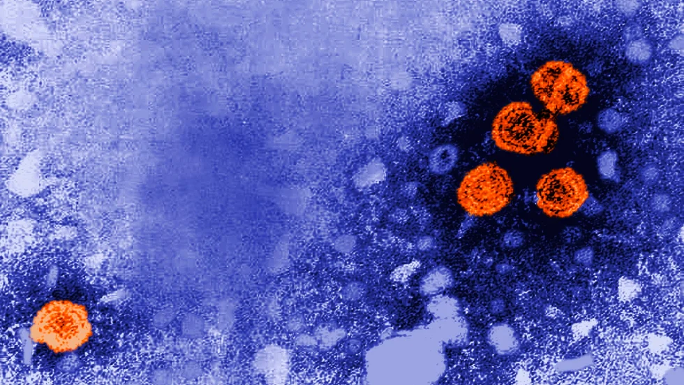 En bild tagen med elektronmikroskop visar hepatit B-viruset (orange), som orsakar en inflammation i levern.