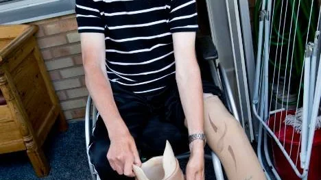 Efter amputeringen i våras har Ingemar Nilsson, 65, fått proteser som ersättare för benen - men han saknar fortfarande den utlovade permobilen.