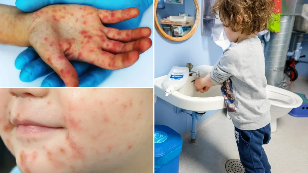 Viruset som orsakar höstblåsor förekommer mest på sensommaren och hösten. Därför kallas infektionen för höstblåsor, skriver 1177.